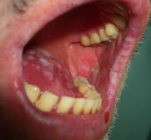 Paraneoplastic pemphigus (erosive lesions on the oral mucosa).