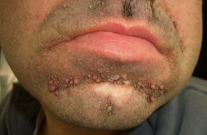 Tuberous sclerosis (facial angiofibromas).