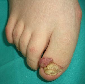 Tuberous sclerosis (Koenen tumor).