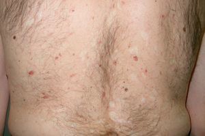 Gorlin syndrome (multiple basal cell carcinomas).