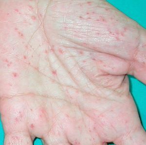 Gorlin syndrome (palmar pits).