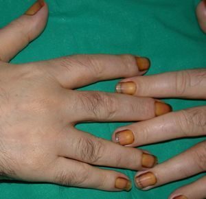 Yellow nail syndrome.