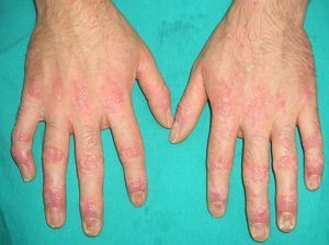 Paraneoplastic pemphigus (lichenoid lesions on the hands and nail dystrophy).