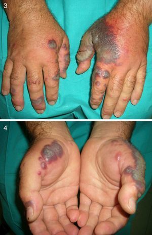 Sweet syndrome (hemorrhagic lesions on the hands).
