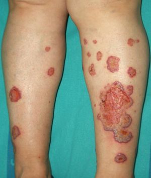 Superficial pyoderma gangrenosum.