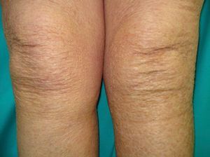 Ichthyosis acquisita.