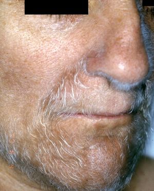 Acquired hypertrichosis lanuginosa (courtesy of Dr. J Sánchez Estella).