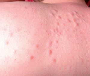 Segmental leiomyomas on the left shoulder.