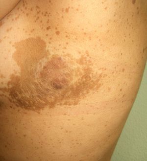 Neurofibromatosis type I (plexiform neurofibroma).