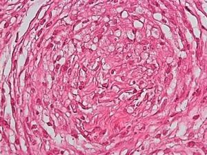 Granuloma in tuberculoid leprosy, showing foamy histiocytes arranged in a concentric pattern. Hematoxylin-eosin, original magnification ×400.