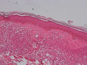 Lepromatous leprosy. Epidermal atrophy with a Grenz zone. Macrophages and foamy areas around blood vessels can be seen. Hematoxylin-eosin, original magnification ×100.
