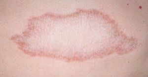 Tuberculoid leprosy: a single, hairless plaque with well-defined borders.