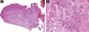 Pyogenic granuloma. A, Hyperkeratosis and acanthosis of the epithelium and a polypoid, ulcerated tumor composed of vascular channels (hematoxylin-eosin, original magnification ×10). B, Detail of the lobular proliferation of capillaries in an edematous stroma (hematoxylin-eosin, original magnification ×40).