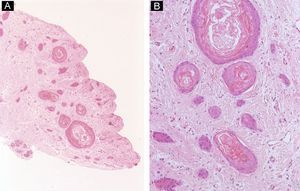 Subungual epidermoid inclusions. A, The dermis contains a number of cystic structures full of keratin (hematoxylin-eosin, original magnification ×10). B, Detail of the cystic inclusions (hematoxylin-eosin, original magnification ×40).