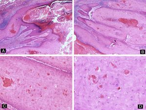 Distal digital keratoacanthoma. A and B, Low-power view. Hyperkeratosis, acanthosis and hypergranulosis of the epithelium associated with a lobular proliferation of intensely eosinophilic squamous cells derived from the epithelium (hematoxylin-eosin, original magnification ×10). C and D, Well-differentiated squamous cells with intensely eosinophilic cytoplasm showing focal dyskeratosis (hematoxylin-eosin, original magnification: C ×20, D ×40).