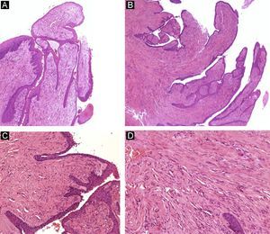 Onychomatricoma. A and B, Presence of a fibroepithelial tumor with villous projections, covered by an epithelium showing acanthosis (hematoxylin-eosin, original magnification ×10). C, Detail of the fibrous projections covered by epithelium (hematoxylin-eosin, original magnification ×20). D, High-power view showing spindle-shaped cells embedded in a collagenous stroma (hematoxylin-eosin, original magnification ×20).