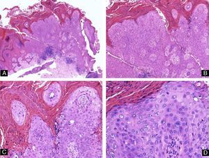 Bowen disease. Hyperkeratosis, parakeratosis, and keratinocyte dysplasia affecting the full thickness of the epithelium (hematoxylin-eosin, original magnification: A ×4, B ×10, C ×20, and D ×40).
