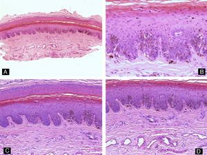 Melanocytic nevus. There is benign melanocytic proliferation in the nail bed (hematoxylin-eosin, original magnification: A ×10, B ×40, C ×20, and D ×20).