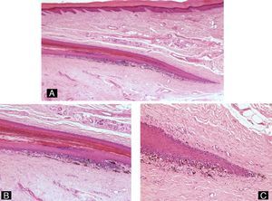 In situ melanoma. Proliferation of atypical melanocytes in a lentiginous pattern and in nests occupying the matrix and nail bed (hematoxylin-eosin, original magnification: A ×10, B ×20, and C ×40).