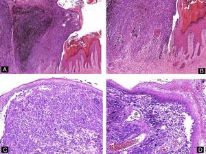 Subungual malignant melanoma. A, Acanthosis and hyperkeratosis of the epithelium associated with an exophytic tumor with abundant melanin (hematoxylin-eosin, original magnification ×4). B, Detail showing the spindle-shaped morphology of the invasive melanocytes and the lentiginous proliferation of atypical melanocytes in the adjacent epithelium (hematoxylin-eosin, original magnification ×10). C and D, High-power view showing the atypical melanocytes and mitotic activity (hematoxylin-eosin, original magnification ×20).