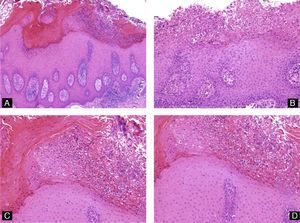 Psoriasis of the nail. There is hyperkeratosis, parakeratosis, psoriasiform hyperplasia of the epithelium, and accumulation of neutrophils in the corneal layer (hematoxylin-eosin, original magnification: A ×10; B, C, and D ×20).