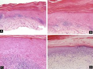 Lichen planus of the nail. There is hyperkeratosis, acanthosis of the epithelium, and a lichenoid lymphocytic infiltrate in the dermis. Degeneration of the basal layer can be seen, with dyskeratotic keratinocytes and Civatte bodies (hematoxylin-eosin, original magnification: A ×10, B ×20, C ×40, and D ×20).