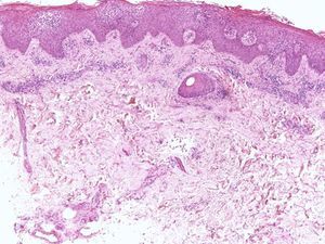 Eczema of the nail. Marked spongiosis and lymphocyte exocytosis. A perivascular lymphocytic infiltrate is present in the dermis (hematoxylin-eosin, original magnification ×20).