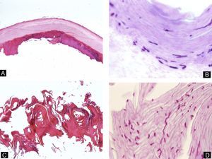 Distal subungual onychomycosis. A, Nail plate and the adherent part of the nail bed, which shows acanthosis and the abnormal presence of a granular layer in the epithelium (hematoxylin-eosin, original magnification ×10). B, Same sample as A showing the presence of hyphae in the deepest part of the nail plate (periodic acid-Schiff, original magnification ×40). C, Incisional biopsy. Fragments of the dystrophic nail plate with very marked hyperkeratosis (hematoxylin-eosin, original magnification ×10). D, Evidence of hyphae in the nail sample (periodic acid-Schiff, original magnification ×40).