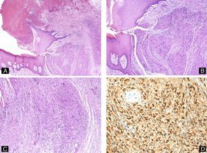 Subungual schwannoma. A, Ulceration, nail dystrophy, and a polypoid tumor formed of spindle-shaped cells (hematoxylin-eosin, original magnification ×10). B and C, Details of the proliferation of spindle-shaped cells with Verocay bodies (hematoxylin-eosin, original magnification ×20). D, Immunohistochemistry showing positivity of the tumor cells for S100.