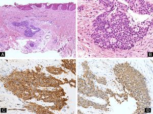 Glomus tumor. A, The tumor is visible in the dermis, deep to the nail bed (hematoxylin-eosin, original magnification ×10). B, High-power view showing tumor cells of cuboidal morphology (hematoxylin-eosin, original magnification ×40). C, Immunohistochemistry showing the tumor cells to be positive for smooth muscle actin (original magnification ×40). D, Immunohistochemistry showing positivity of the tumor cells for CD34 (original magnification ×40).
