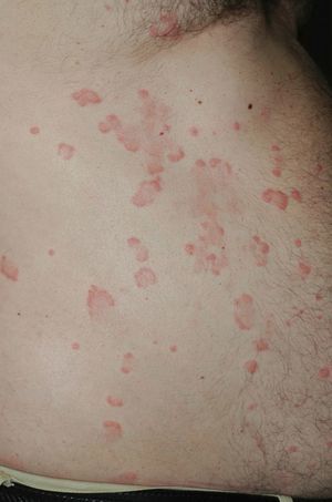 Urticarial plaques with purpuric borders on the trunk.