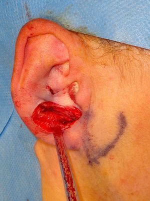 Surgical defect affecting the cartilage of the antitragus.