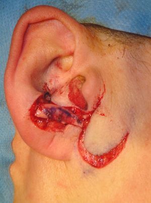 Cartilage graft to the antitragus fixed with resorbable suture.