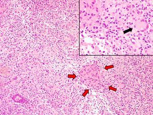 Note the presence of a granuloma composed of histiocytes (red arrows). To the right of this is a multinucleated giant cell (black arrow). Note the higher magnification in top right-hand corner of the image. Hematoxylin-eosin ×20.