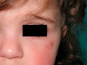 The lesion resolved spontaneously leaving a residual pink macule.