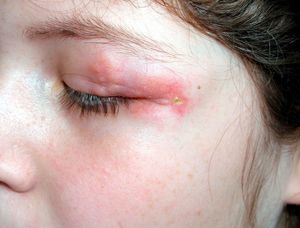 Yellowish-red plaques in the periocular region.