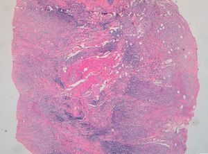 Inflammatory infiltrate composed of histiocytes with degenerated collagen and lipid deposits (hematoxylin-eosin, original magnification×40).