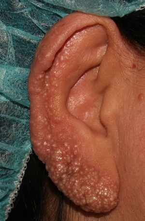 Multiple grouped smooth cystic lesions on the right helix and ear lobe.