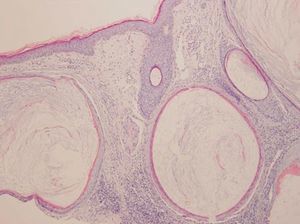 Follicular infundibular cysts with a perifollicular foreign body–type granulomatous infiltrate response (hematoxylin-eosin, original magnification ×10).