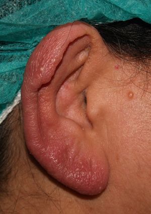Marked reduction in the number of cysts after treatment with photodynamic therapy.