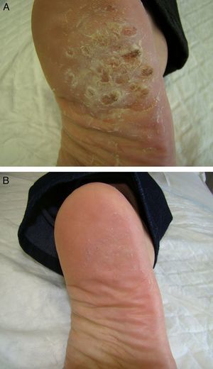 A, Patient 1. Group of viral warts on the right heel. B, Patient 1. 8 weeks after treatment.