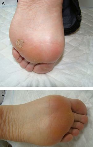 A, Patient 2. Very painful wart located on the left arch. B. Patient 2. 10 weeks after treatment.