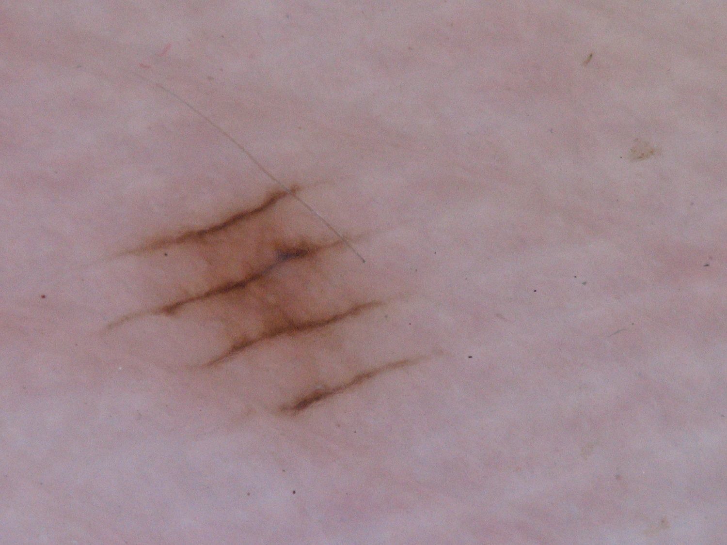 volar melanotic macules Representative dermoscopic patterns seen in melanocytic lesions on main image 0