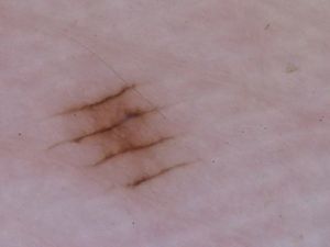 Parallel furrow pattern in a melanocytic nevus located on the thenar eminence of the right palm of a 36-year-old woman.