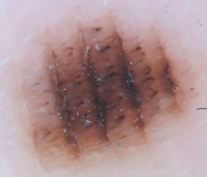 Parallel furrow pattern with globules in the ridges in a melanocytic nevus located on the arch of the right sole of a 33-year-old man.
