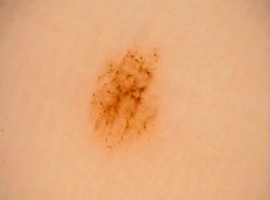 Globular pattern associated with a parallel furrow pattern on the heel of the left sole of a 27-year-old woman.