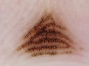 Parallel furrow pattern (double dotted-line variant) in the center of the right palm of a 46-year-old man.