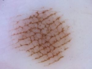 Latticelike pattern in a melanocytic nevus on the external aspect of the left sole of a 53-year-old man.