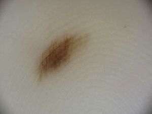 Fibrillar pattern in a melanocytic nevus on the right heel of a 31-year-old man.