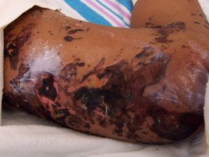 Widespread areas of purpura and necrosis on right lower extremity with lysed bullae and crusting.